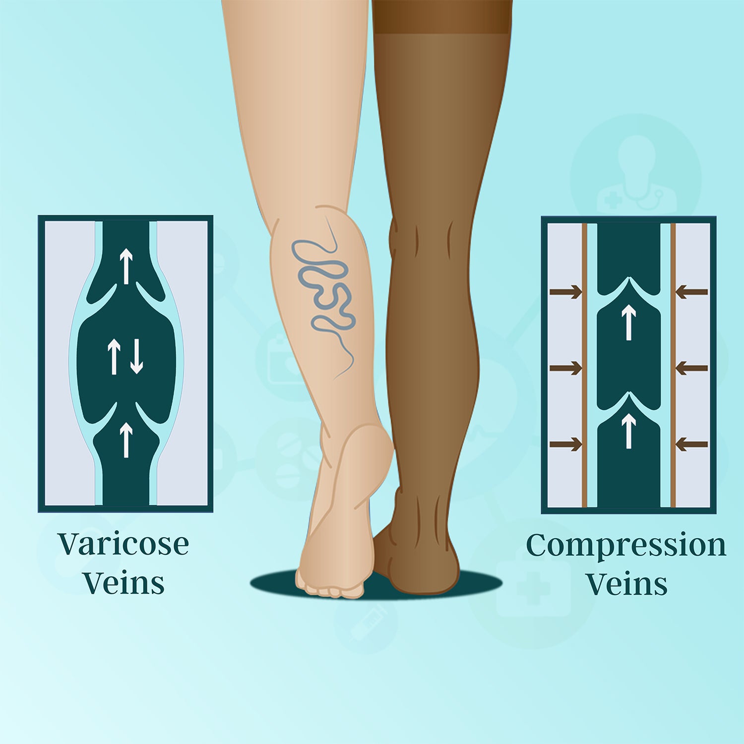 Medtex Class-3 compression stockings for Lymphedema,Edema and Severe Varicose veins