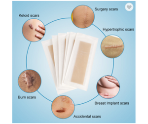 Medtex silicone gel sheet for scar treatment and keloid managementSilicone Gel Sheet, Scar Gel sheet for Keloid scars