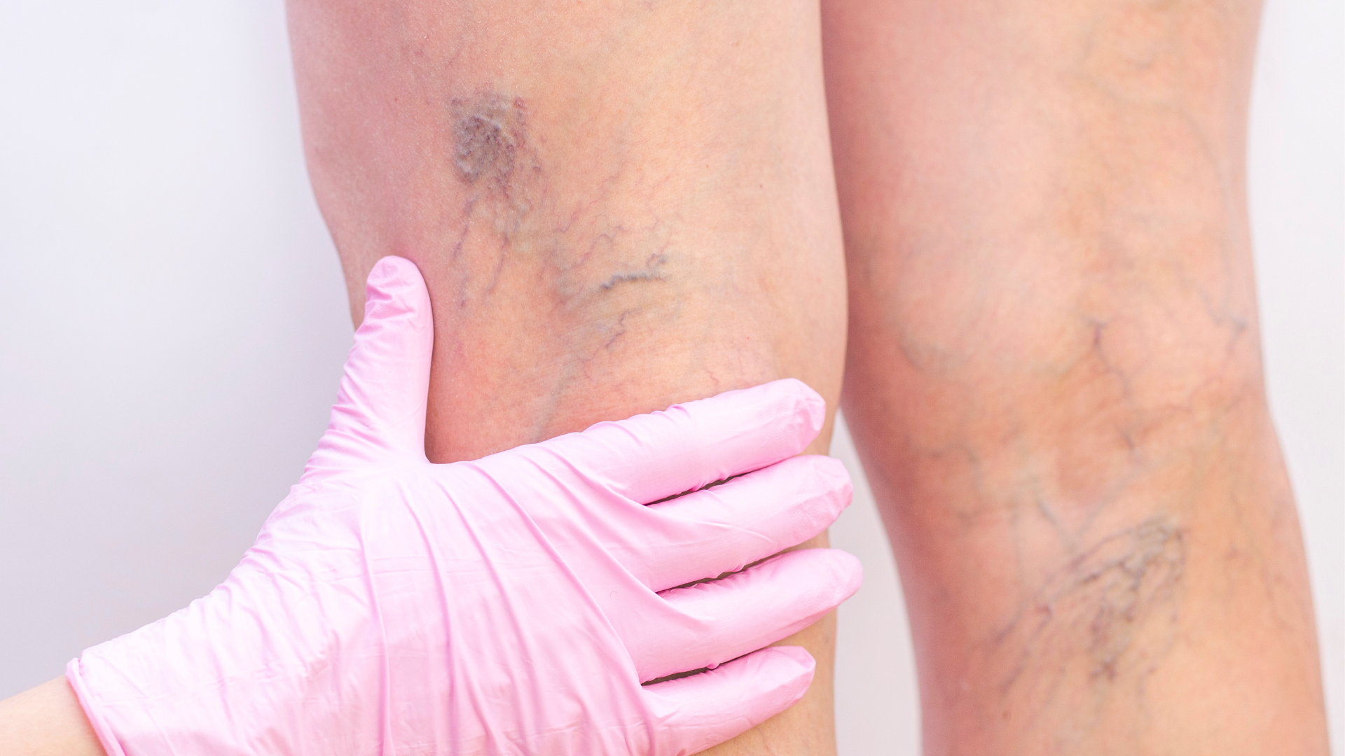 What to Do if Your Green Veins Are Painful